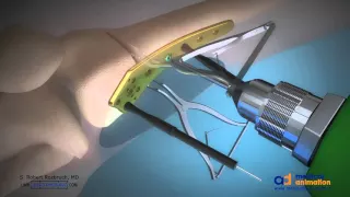 Distal Femoral Osteotomy Animation