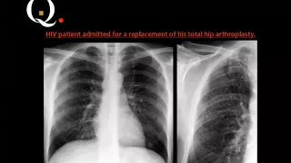 Chest imaging quiz III  Prof Dr  Mamdouh Mahfouz In Arabic