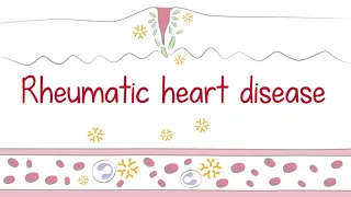 University of Minnesota - Rheumatic heart disease | Explainer Animation by F. Learning Studio