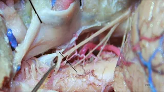 Far lateral approach for microsurgical ligation of C1 dAVF: surgical anatomy and technical nuances