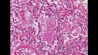 Histopathology Lung--Pneumocystis pneumonia