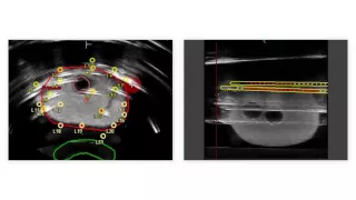 Real-time Prostate Solutions for treating prostate cancer with brachytherapy