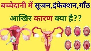 बच्चेदानी में सूजन, इंफेक्शन, गांठ होने के कारण और घरेलू उपाय/ bachedani me sujan, infection