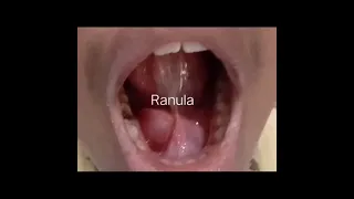 Ranula Vs Epidermoid cyst