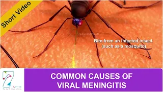 COMMON CAUSES OF VIRAL MENINGITIS