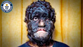 The World's Hairiest Family - Guinness World Records