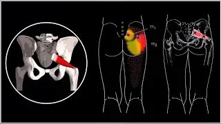 PIRIFORMIS SYNDROME AND A PINCHED SCIATIC NERVE