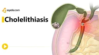 Cholelithiasis -II | Gastroenterology Medicine Animation | Medical V-Learning