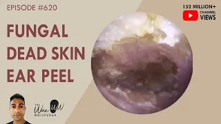 620 - Fungal Dead Skin Peel off Entire Ear Canal & Eardrum