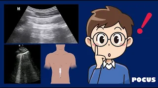 A- and B-lines on abdominal ultrasound: POCUS pearls - Dr. Koratala (@NephroP)