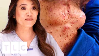 CYST-ception: A Cyst INSIDE A Cyst (SQUIRT-ALERT!) | Dr. Pimple Popper