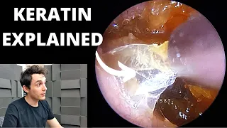 Dead Skin Quagmire Suctioned From Ear (Keratin Explained)