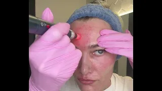 Microneedling Technique - Forehead