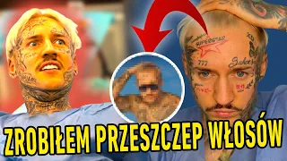 ZROBIŁEM PRZESZCZEP WŁOSÓW. STIFLER ŁYSIEJE!