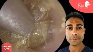 1,137 - Extremely Itchy Blocked Ear Wax Removal