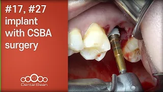 #17, #27 implant with CSBA surgery - [Dr. Cho Yongseok]