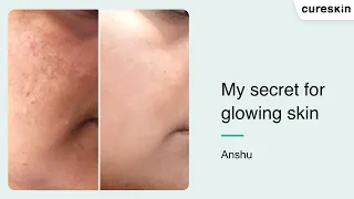 "In Just 15 Days, I Noticed a Remarkable Improvement" - Anshu | Cureskin review