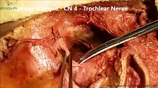 ORBIT OCULAR MUSCLES OPTIC Nerve OPHTHALMIC Artery CN6 and Clinicals – Sanjoy Sanyal – Proceum