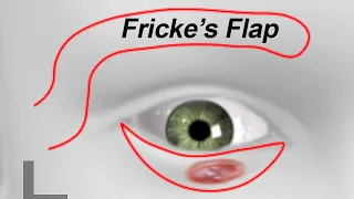 Fricke’s Flap After Lower Eyelid Cancer Excision