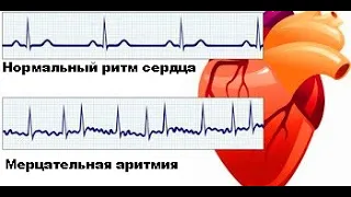 Лечение фибрилляции предсердий (мерцательной аритмии) в ФНКЦ ФМБА России