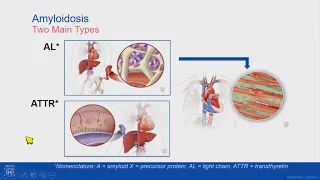 Treatment Update: Medications for Cardiac Amyloidosis