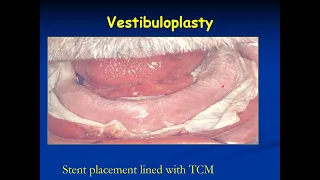 4-Flat Residual Alveolar Ridge