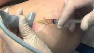 Ultrasound guided sclerotherapy