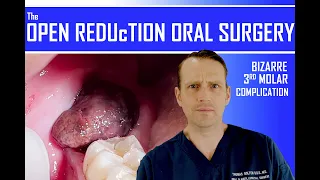 BIZARRE COMPLICATION after THIRD MOLAR REMOVAL | WISDOM TOOTH SURGERY