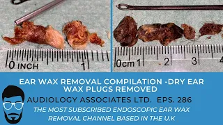 EAR WAX REMOVAL COMPILATION - DRY EAR WAX PLUGS REMOVED - EP 286