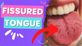 FISSURED TONGUE - WHAT IS IT - WHAT CAUSES IT? HOW TO MANAGE IT!