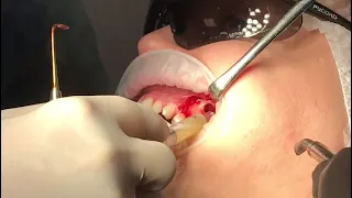 Retention cyst of maxillary sinus