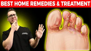 Athlete's Foot Fungus [BEST Home Remedies & Treatment]