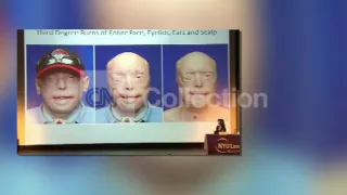 NYU FACE TRANSPLANT PATIENT BEFORE SURGERY