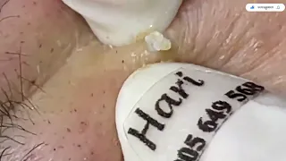 Removing Small Pimples with Hari's -  Satisfying