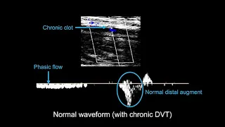 Venous ultrasound course: Deciphering DVT waveforms