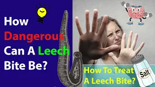 How Dangerous Can A Leech Bite Be?  | How To Treat A Leech Bite