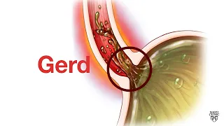 Mayo Clinic Minute - GERD is not 'just' heartburn