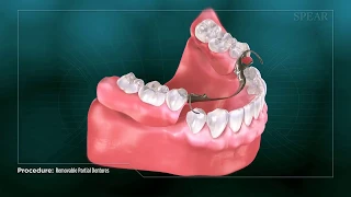 Removable Dentures