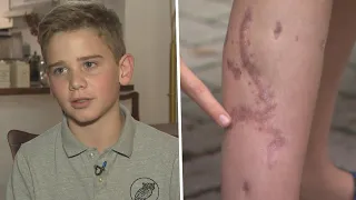 12-Year-Old Attacked by Crocodile Nearly Lost His Leg