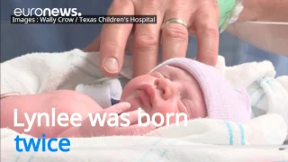 Meet the miracle baby who was 'born twice'