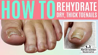 👣How to Rehydrate a Dry, Thick Toenail👣