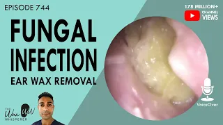 744 - Fungal Ear Infection Ear Wax Removal