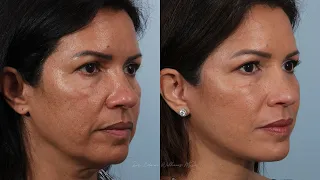Day by Day Deep Plane Facelift Surgery Recovery