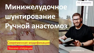 Минижелудочное шунтирование с ручным анастомозом. Новая техника с минимальным расходом кассет.