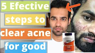 Naturally clear your acne and heal your body for good! #pantothenic acid