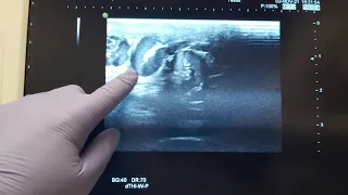 Varicocele Diagnose with the help of Color Doppler Ultrasound