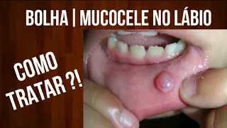 🎈BOLHA | MUCOCELE NO LÁBIO COMO TRATAR ?!