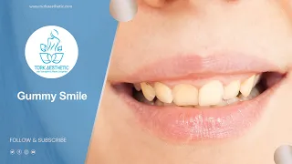 Gummy Smile Treatment in Turkey (30) Minutes - Turk Aesthetic