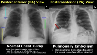 Chest X-Ray Lung Normal Vs Abnormal Image Appearances Part 2 | Pleural Effusion/Pneumothorax PA CXR