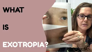 What Is Exotropia And How Do We Treat It?